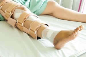 A woman with a surgically repaired leg wearing a leg brace.