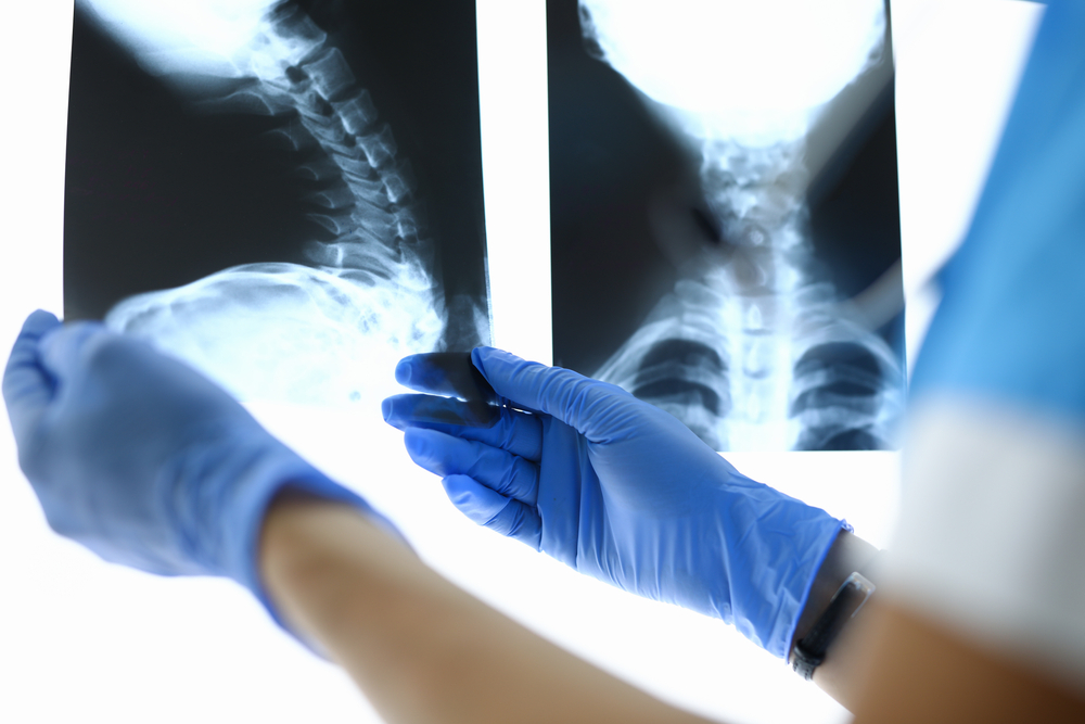 Doctor reviewing spinal X-ray images used to evaluate the severity of a spinal cord injury