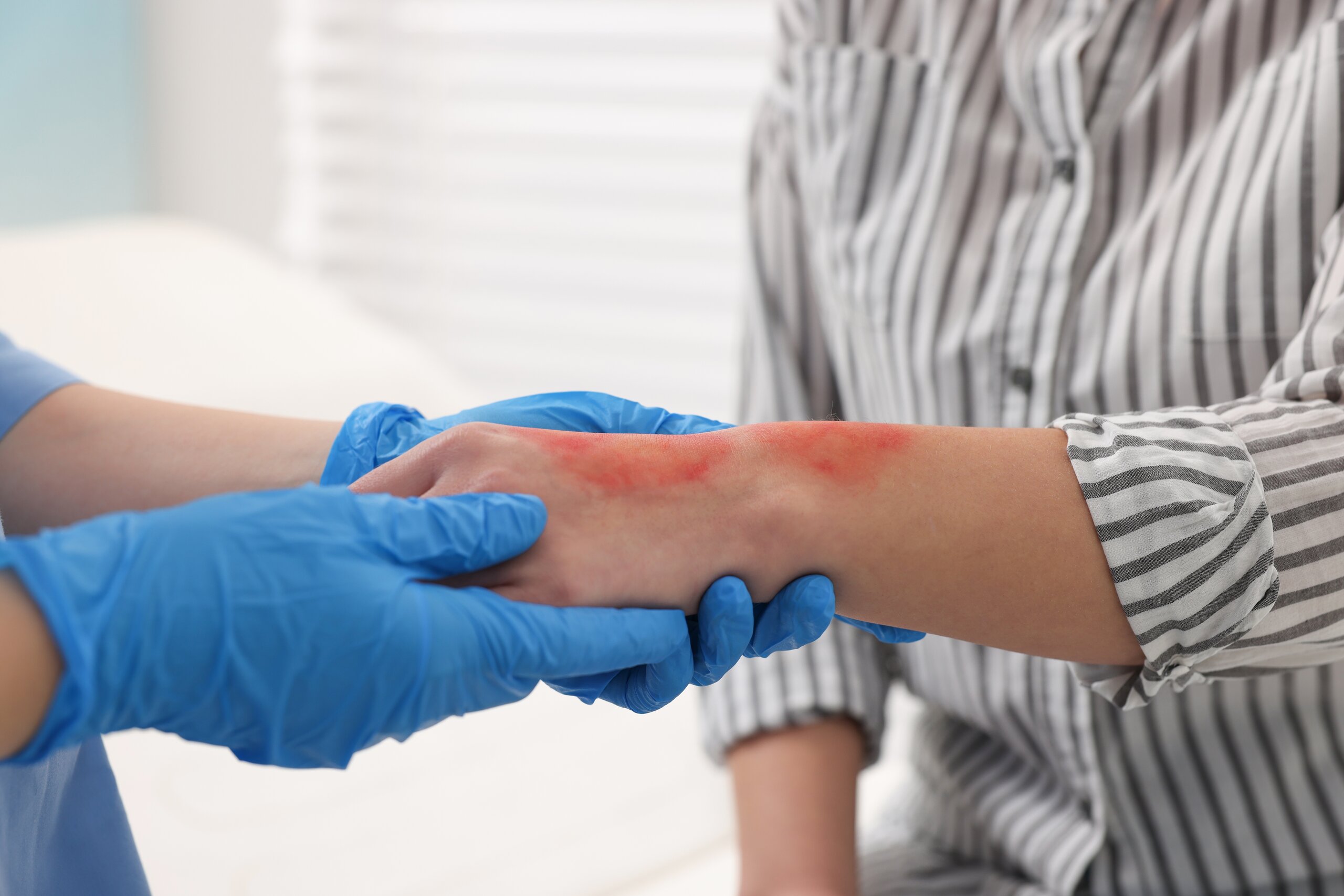 Medical professional examining a burn injury on a patient